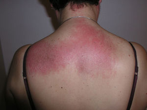 Shawl sign. Confluent macular violaceous erythema on the nape of the neck, back and shoulders.