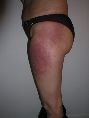 Holster sign. Violaceous erythema on the lateral surface of the thighs, where imaginary holsters might lie.