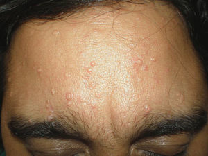 Patient 1, showing facial multiple sebaceous hyperplasia secondary to maintenance immunosuppressive therapy using ciclosporin.
