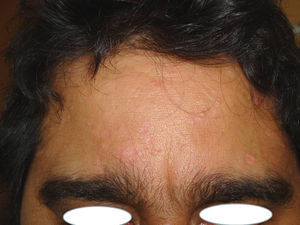Patient 1 after treatment with pulsed dye laser. He continued with the immunosuppressive therapy.