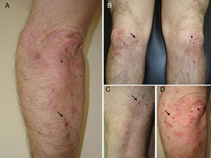 Psoriatic plaques (asterisks) and multiple excoriated vesicles (arrows). The lesions are spread over the extensor surfaces of the legs and arms. A, Right elbow. B, Knees. C, Detail of right knee. D, Detail of right elbow.