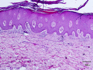 Histology of a biopsy specimen from a psoriatic plaque on 1 of the elbows shows epidermal acanthosis, hyperkeratosis with parakeratosis, and perivascular and interstitial inflammatory infiltrates (hematoxylin-eosin, original magnification x10).