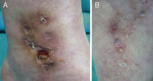 A, Pearly stellate macules on the pretibial region, surrounded by punctate erythematous lesions and brownish macules. B, Ulcer with well-defined, rounded borders and a clean base and slightly depressed whitish macules.