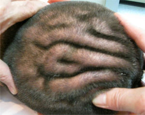 Clinical image of furrows and folds on the patient's scalp.