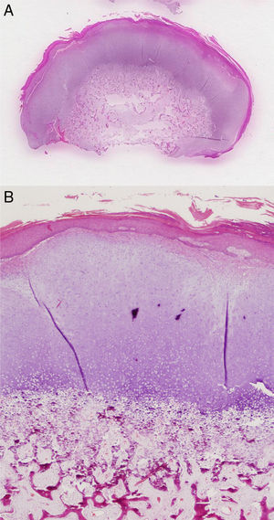 A and B, Histological findings (hematoxylin-eosin staining) showing the surface of the lesion with a mature osteocartilaginous cap and a transitional area with signs of enchondral ossification and bone tissue trabeculae. B, Lax, highly vascularized fibrous tissue in the lower part of the image.