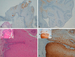 A and B, Negative staining for p16 in genital warts (positivity only in isolated cells). A, p16 staining (original magnification x16); inset shows hematoxylin and eosin (original magnification x16). B, p16 staining (original magnification x40). C and D, Genital wart of the vulva with a positive area for p16, without histologic evidence of carcinoma. C, Hematoxylin and eosin staining (original magnification x100). D, p16 staining (original magnification x100). Insets in C and D show lower-magnification views (original magnification x40).