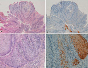 Genital wart of the vulva with an area of severe dysplasia-in situ SCC positive for p16 staining. A and C, Hematoxylin and eosin staining (original magnification x16 and x100, respectively). B and D, p16 staining (original magnification x16 and x100, respectively).