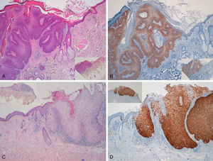 Intensely positive staining for p16 in samples from 2 patients with extragenital Bowen disease. A and C, Hematoxylin and eosin staining (original magnification x40). B and D, Staining for p16 (original magnification x40). Insets in C and D show lower-magnification views (original magnification x16).
