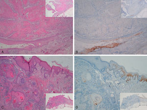 Invasive squamous cell carcinoma of the extragenital area. Focally positive staining for p16 in the epidermis adjacent to the carcinoma with severe dysplasia and/or actinic keratosis, negative in the invasive area of the tumor. A and C, Hematoxylin and eosin staining (original magnification x40). B and D, p16 staining (original magnification x40). Insets show lower-magnification views (original magnification x16).