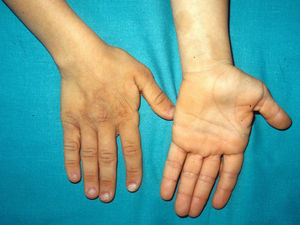 Costello syndrome. Rough, redundant skin on the dorsum of the hands and deep lines on the palms.