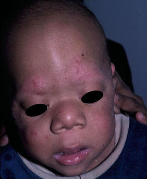 Cardiofaciocutaneous syndrome. Typical facial appearance of the syndrome with characteristic ulerythema ophryogenes on the eyebrows (image courtesy of Dr Eulalia Baselga).
