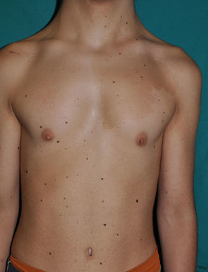 Noonan syndrome. Patient with multiple nevi on the trunk and a large café-au-lait spot on the upper left chest. Note also the slightly sunken chest and the widened neck (pterigium colli).