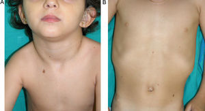 LEOPARD syndrome. A, Lentigines on the upper trunk of a girl with LEOPARD syndrome. The patient had a mutation in PTPN11 associated with deafness and ocular hypertelorism. Also note the low-set ears and wide neck, which are common phenotypic findings in Noonan syndrome. B, Lentigines on the front of the trunk (image courtesy of Dr Ana Martín Santiago).