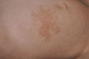 Type-1 neurofibromatosis. Congenital superficial plexiform neurofibroma on the abdomen.