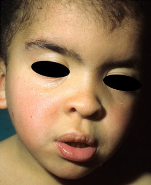 Costello syndrome. Typical facial appearance with low hairline, depressed nasal bridge, epicanthus, chubby cheeks, and a large mouth with thick lips.