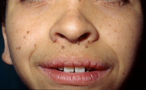 Costello syndrome. Papillomatous growths below the nose and on the right cheek.