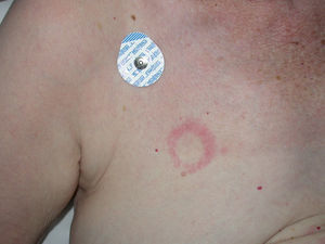 The shape of a lesion can lead to suspicion of allergic contact eczema. In this case, the skin was sensitized to the adhesive used to attach an electrocardiographic lead.