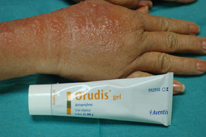Severe acute allergic eczema caused by a nonsteroidal anti-inflammatory cream was suspected.