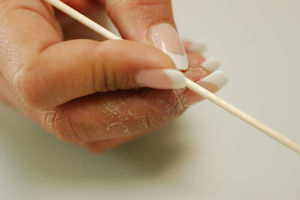 Hand eczema on the tips of the first 3 fingers of a beautician who worked with artificial nails. Possible sensitization to acrylics.