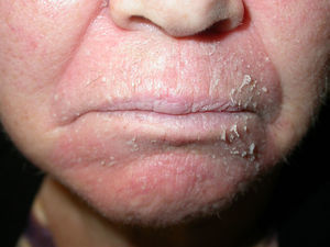 Exacerbation of seborrheic dermatitis. Possible sensitization to topical medication.
