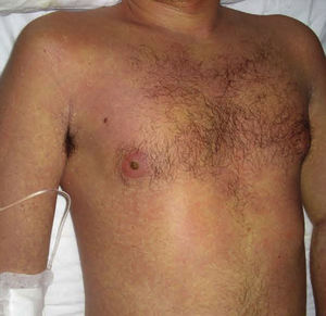 Confluent maculopapular rash on the trunk, with a negative Nikolsky sign.