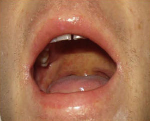 Nagayama spots. Purpuric rash on the soft palate and base of the uvula, characteristic of human herpesvirus 6 infection.10
