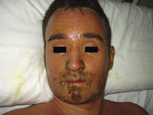 Maculopapular rash, jaundice, and desquamation of the lesions.
