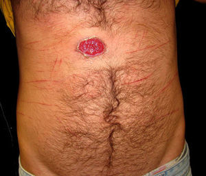 Detail of the ulcerative lesion on the chest. Note the multiple linear lesions in the vicinity of the lesion.