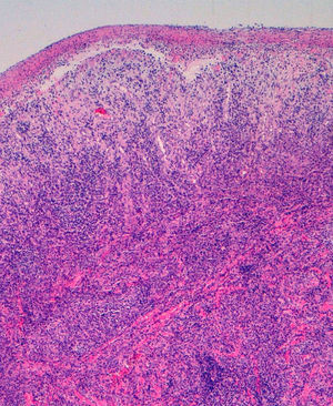 Ulcerative lesion with a fibrin-covered base and a dense lymphoplasmacytic infiltration throughout the dermis (hematoxylin-eosin, original magnification ×100).