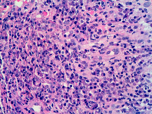 Detail of the lymphoplasmacytic infiltration, with prominent endothelial vessels (hematoxylin-eosin, original magnification ×200).