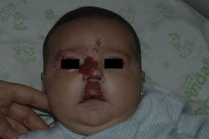 Segmental hemangioma of infancy in S1, S2, and S4 on a 2-month-old girl. Note the marked deformity on the nasal columella and philtrum. Additional tests ruled out PHACE syndrome.