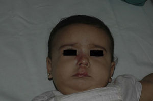 Patient from Figure 1 after 5.5 months of treatment (age 7.5 months).