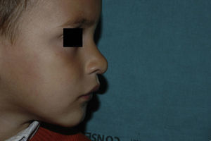 Patient from Figure 3 at 2 years and 10 months of age (9 months after finishing treatment with propanolol).