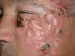 Cutaneous plaque with a shiny, irregular surface and areas of ulceration. The lesion prevented the eye from opening.