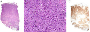 A, Dense lymphocytic infiltrate affecting the full thickness of the dermis and reaching the subcutaneous tissue (hematoxylin-eosin, original magnification x20). B, Lymphoid cells with abundant cytoplasm, marked pleomorphism, mitotic activity, and atypia (hematoxylin-eosin, original magnification, x200). C, Intense positivity for the CD30 marker in almost the entire specimen (x20).