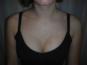 Multiple whitish papules in a V-shaped area on the upper chest.