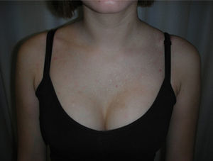 Multiple whitish papules in a V-shaped area on the upper chest.
