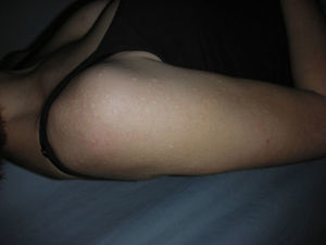 Nonconfluent whitish papules on the shoulders.