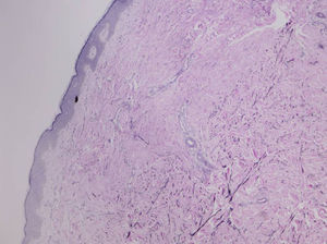 Marked reduction, thinning, and fragmentation of the elastic fibers in the upper dermis (orcein stain).