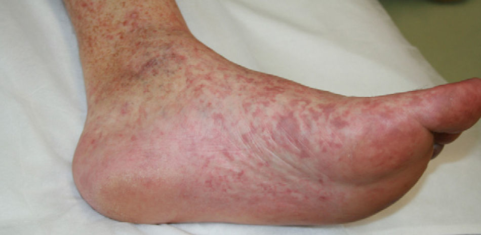 Blue Toe Sign as the Initial Manifestation of a Popliteal Artery ...