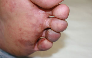 Blue discoloration of the fourth and fifth toes of the left foot, with reticulated violaceous macules on the other toes and on the sole of the foot.