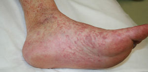 Reticulated violaceous macules extending onto the rest of the foot and towards the distal region of the lower leg.
