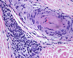 Medium-sized arteriole with a mural thrombus. No signs of vasculitis were observed (hematoxylin-eosin, original magnification x40).