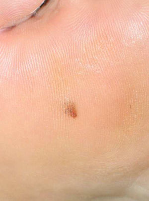 Clinical image of the lesion: pigmented macule on the sole of the foot.