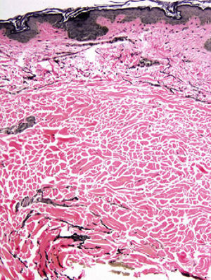Verhoeff-Van-Gieson stain for elastic fibers (original magnification×10).