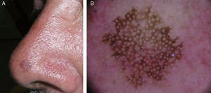 A, Clinical image of the lesion in patient 1. There is a dark brown, pigmented macule of 5mm diameter, with well-defined borders and a slightly rough surface. Part of the border of the lesion is moth-eaten. B, Dermoscopic image of the lesion in patient 1, showing rhomboidal structures and an annular-granular pattern.