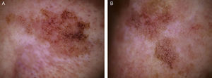 A, Dermoscopic image of the lesion on the right side of the bridge of the nose in patient 4. Rhomboidal structures can be seen on an erythematous background and there is a diffuse grayish-brown granulation. B, Dermoscopic image of the lesion on the left side of the bridge of the nose, showing rhomboidal structures and an annular-granular pattern in the inferior part of the lesion. The same structures were observed in the superior part of the lesion, but with a more reddish color and with a number of fine wavy vessels.