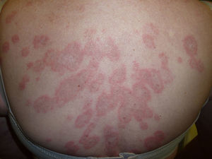 Confluent, ring-shaped erythematous-violaceous plaques on the back.