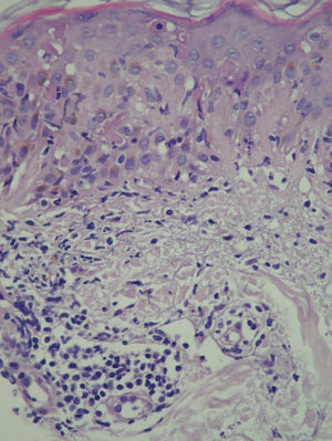 Hyperkeratosis, vacuolar degeneration of the basal layer, discrete lymphocytic exocytosis, and presence of necrotic keratinocytes. Note the superficial perivascular inflammatory infiltrate in the dermis (hematoxylin-eosin, original magnification ×20).