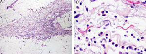 Histopathology image of biopsy sample from the forearm. A, Interlobular septal thickening in the subcutaneous cellular tissue with inflammatory cells (hematoxylin-eosin, original magnification ×40). B, Higher magnification reveals the presence of numerous eosinophils in the subcutaneous cellular tissue adjacent to the septa (hematoxylin-eosin, original magnification ×400).